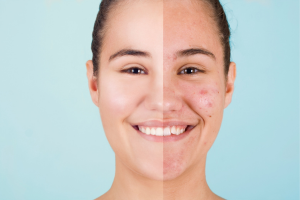 prescription acne treatments